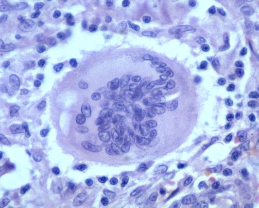 Touton Cells