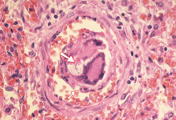 foreign-body-granulomas